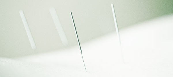 What is Naturopathic Acupuncture?