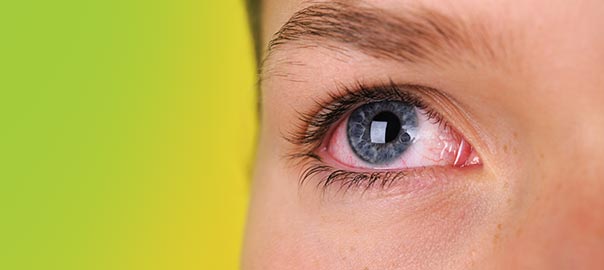 Dry Eye Syndrome – An Insight into the Importance of Omega 3