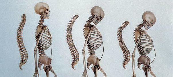 Menopause and Osteoporosis